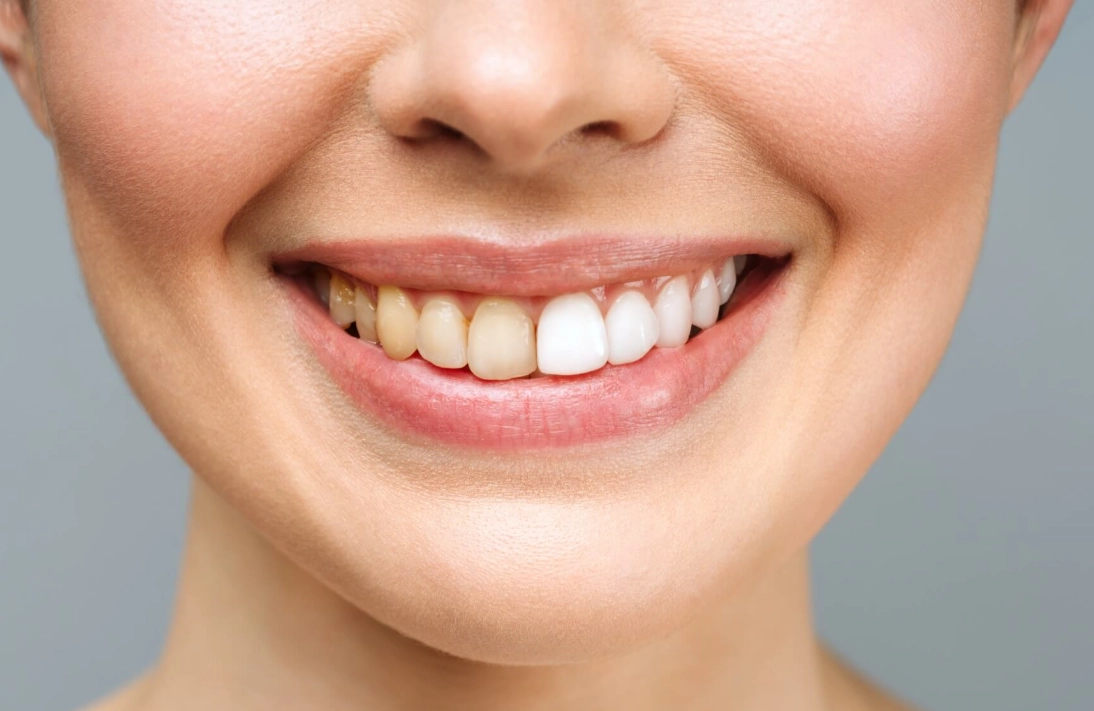 牙齒變黃原因