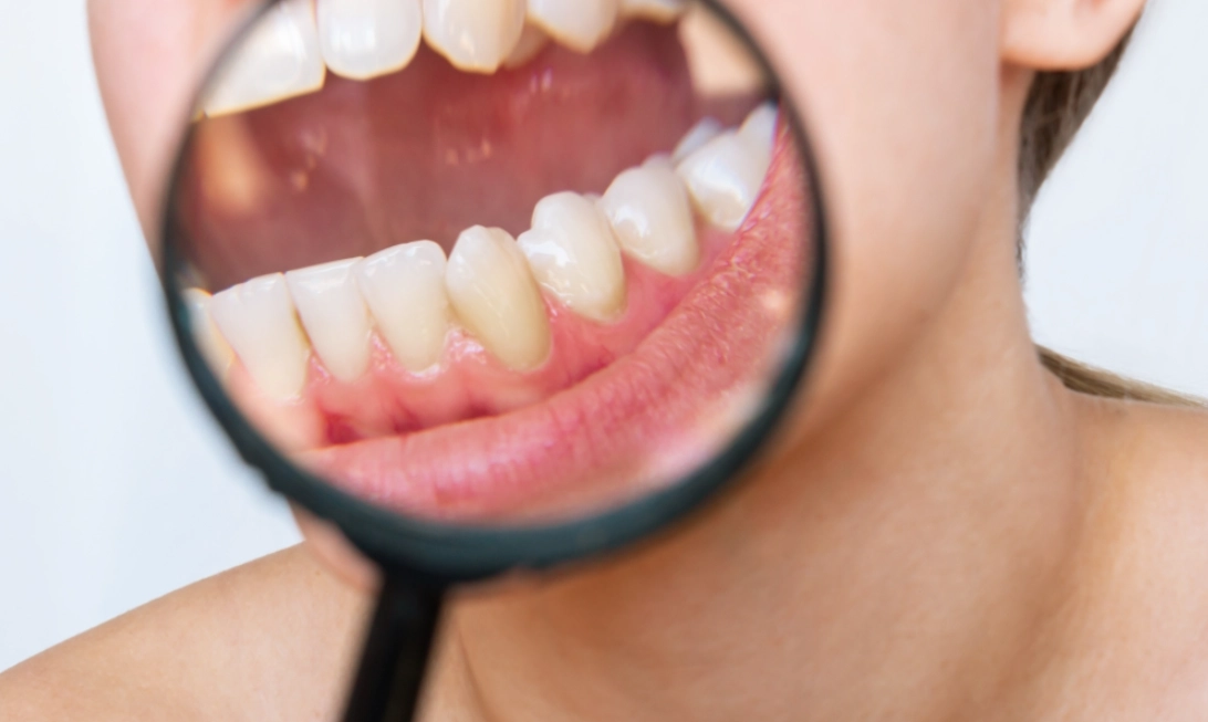 牙齒黃刷不掉怎麼辦？專家教你有效美白與預防對策