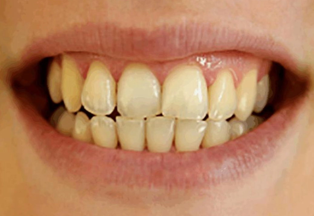 牙齒美白方法