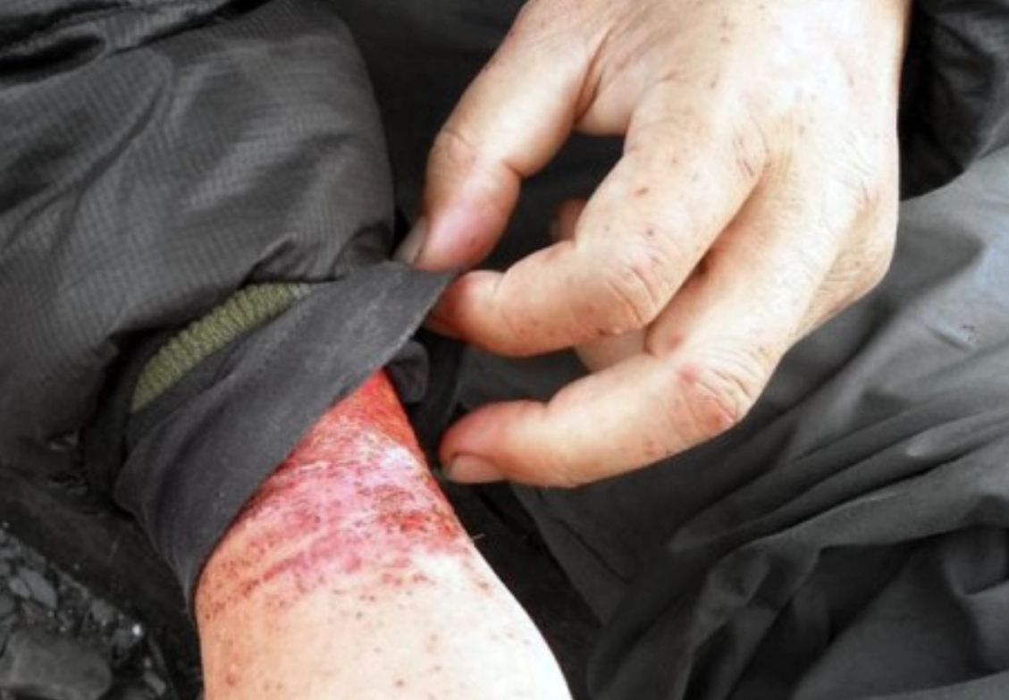 橫紋肌溶解症會自己好嗎？輕症可恢復，但忽視這些症狀恐致腎衰竭