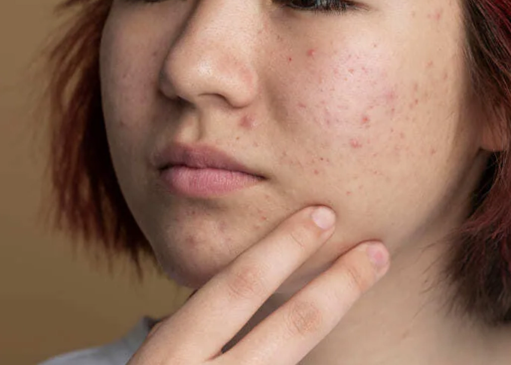 痘疤藥膏選購全攻略：專家教你有效淡化疤痕並避免常見錯誤