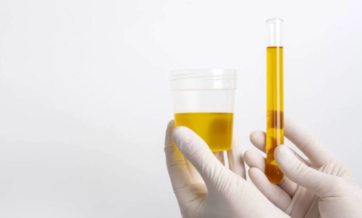 尿液白血球偏高 尿液白血球偏高