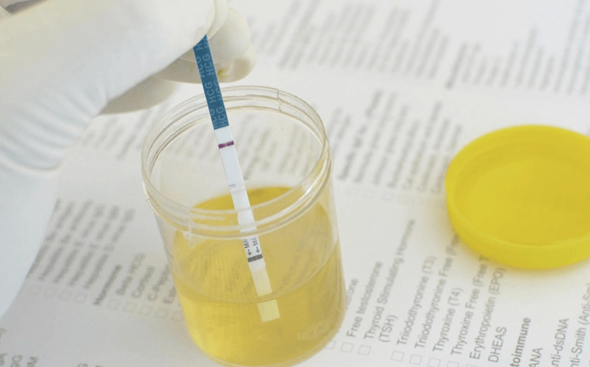 尿液白血球偏高 尿液白血球偏高