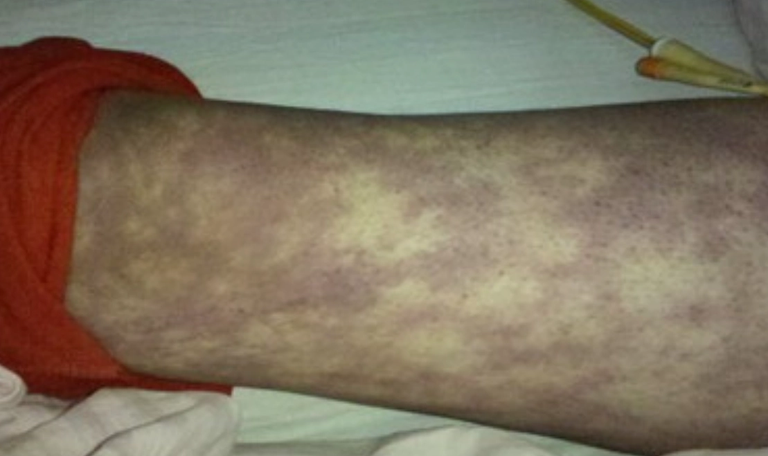 橫紋肌溶解症治療