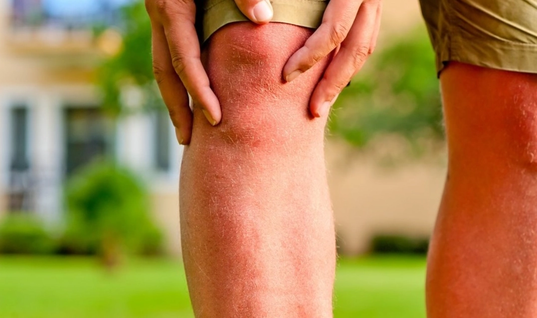 橫紋肌溶解症預防