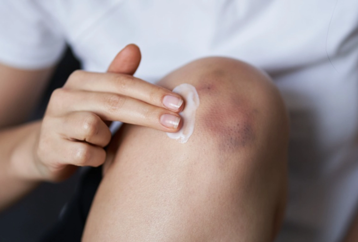 瘀青藥膏怎麼選