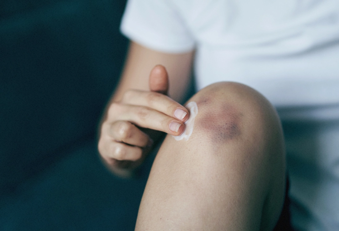 快速消瘀青藥膏選購與使用全指南：專家教你有效處理瘀傷