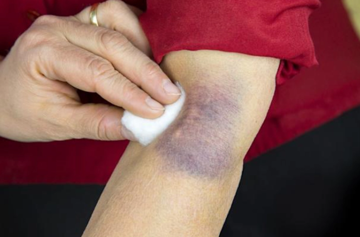 瘀青藥膏怎麼選