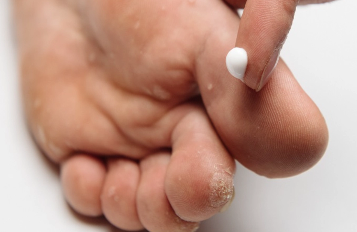 足癬治療 足癬治療