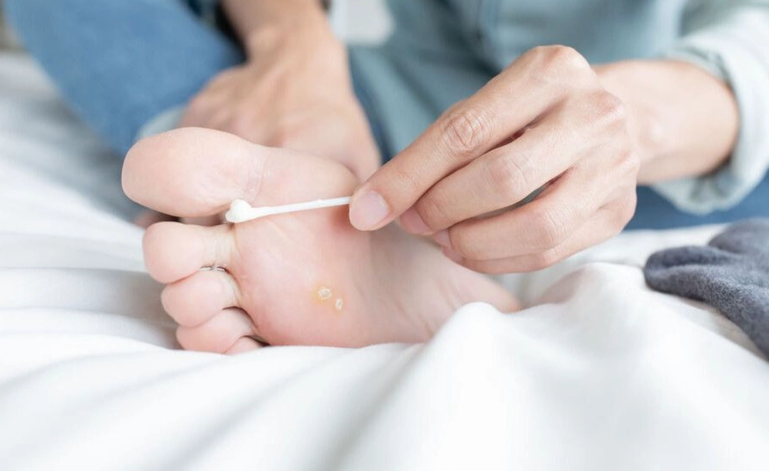 足癬治療 足癬治療