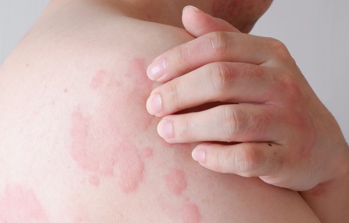 蕁麻疹晚上特別癢 蕁麻疹晚上特別癢