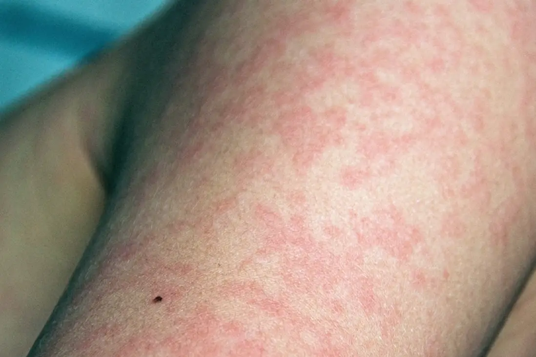 夜間蕁麻疹 夜間蕁麻疹