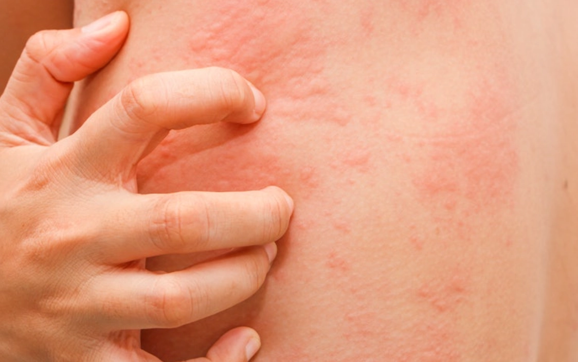 夜晚皮膚癢原因 夜晚皮膚癢原因