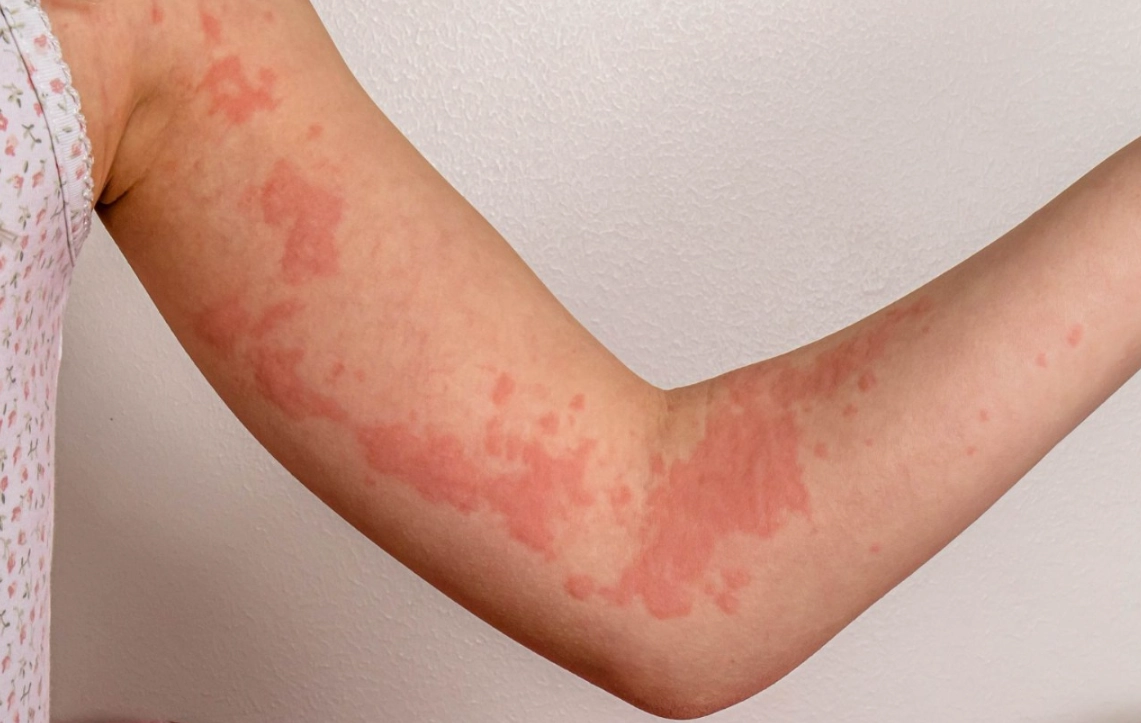 蕁麻疹藥膏推薦