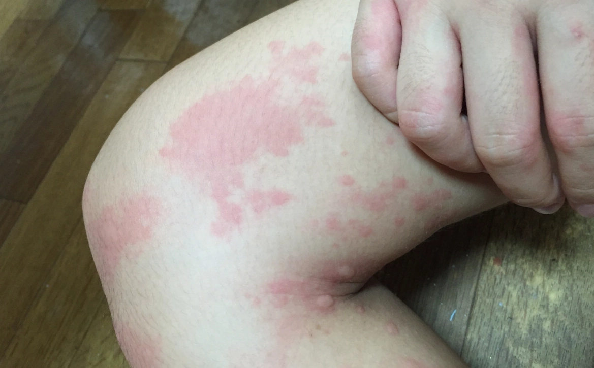 夜間蕁麻疹 夜間蕁麻疹