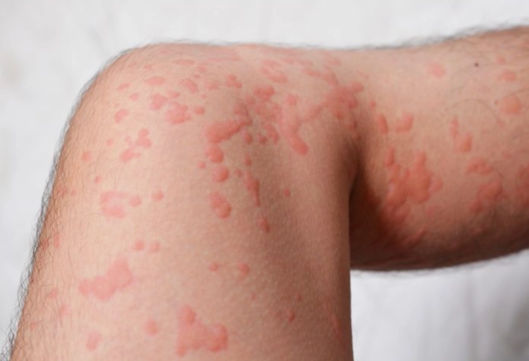 蕁麻疹藥膏推薦