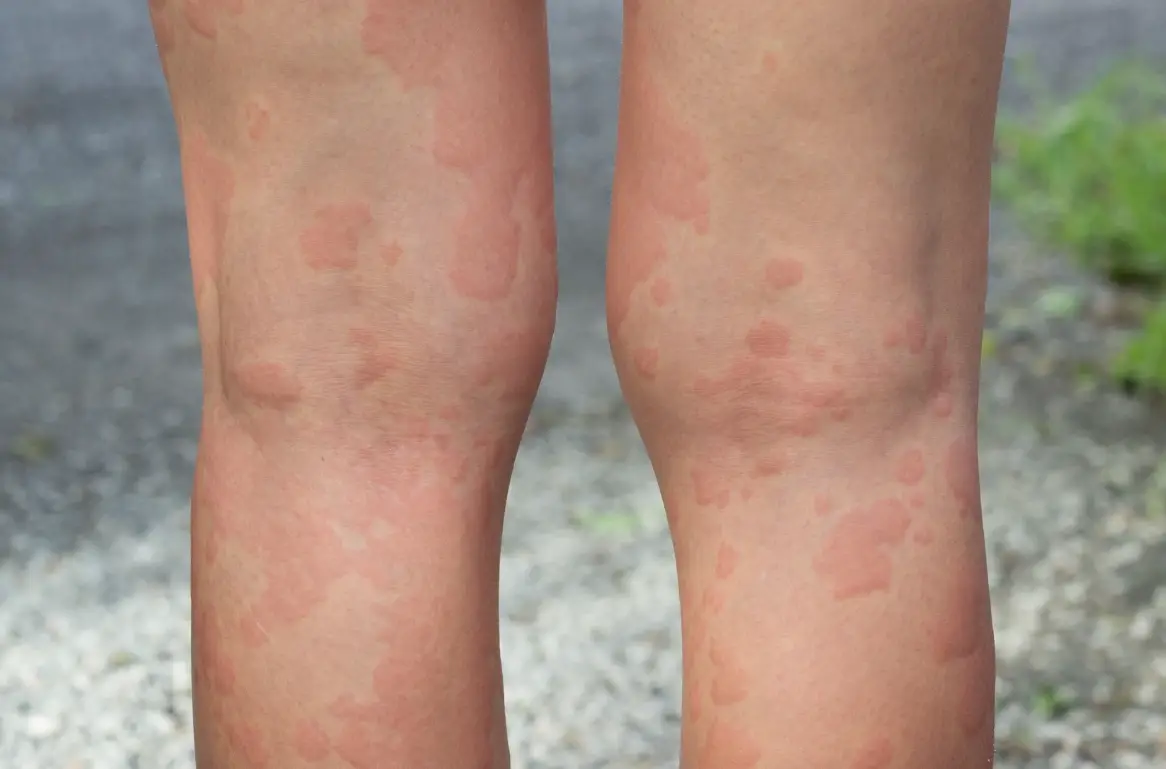 蕁麻疹藥膏推薦