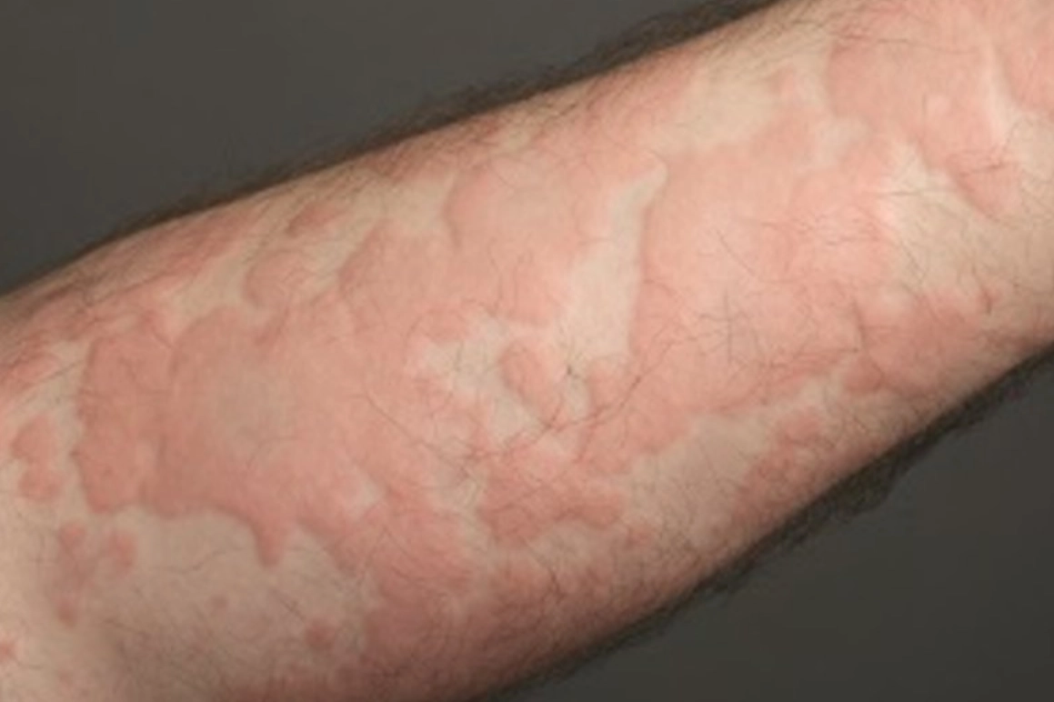 夜間蕁麻疹 夜間蕁麻疹