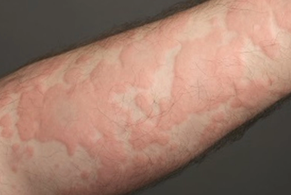 蕁麻疹何時要看醫生 蕁麻疹何時要看醫生