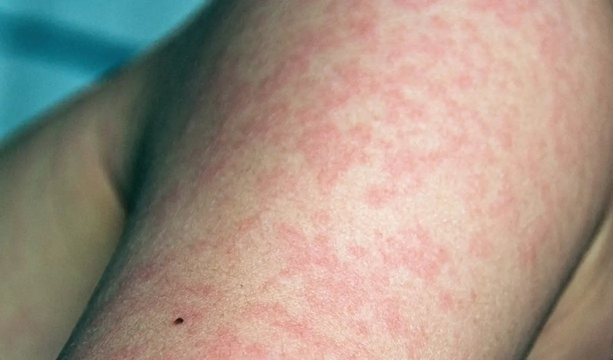 蕁麻疹止癢方法 蕁麻疹止癢方法