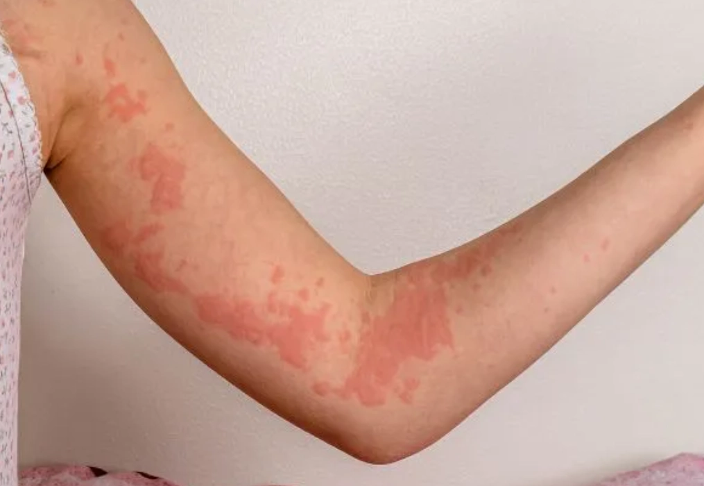 夜間蕁麻疹 夜間蕁麻疹