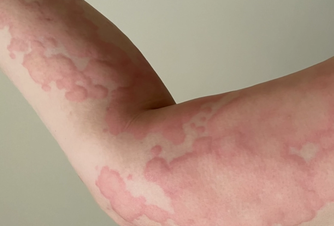 蕁麻疹何時要看醫生 蕁麻疹何時要看醫生