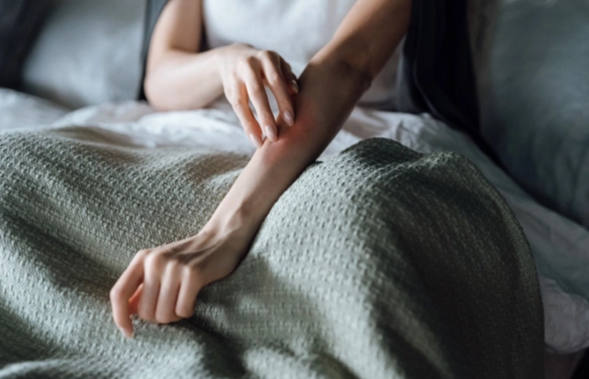 夜間蕁麻疹 夜間蕁麻疹