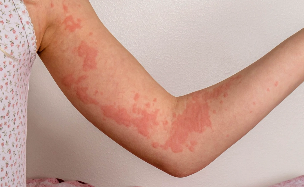 蕁麻疹何時要看醫生 蕁麻疹何時要看醫生