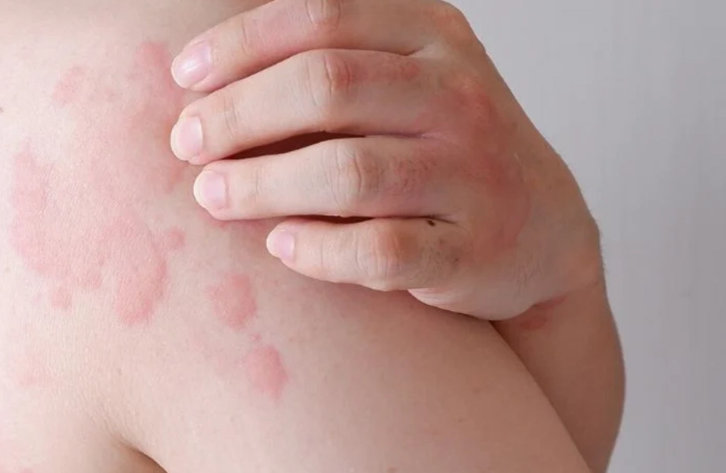 夜晚皮膚癢原因 夜晚皮膚癢原因