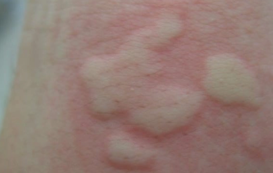 夜間蕁麻疹 夜間蕁麻疹