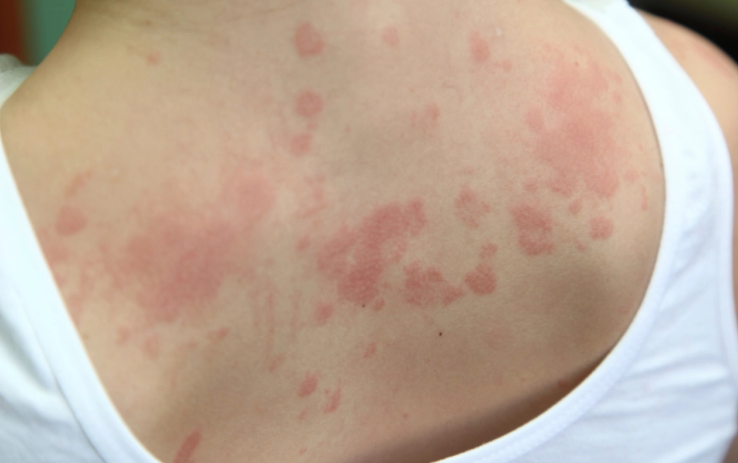 蕁麻疹晚上特別癢