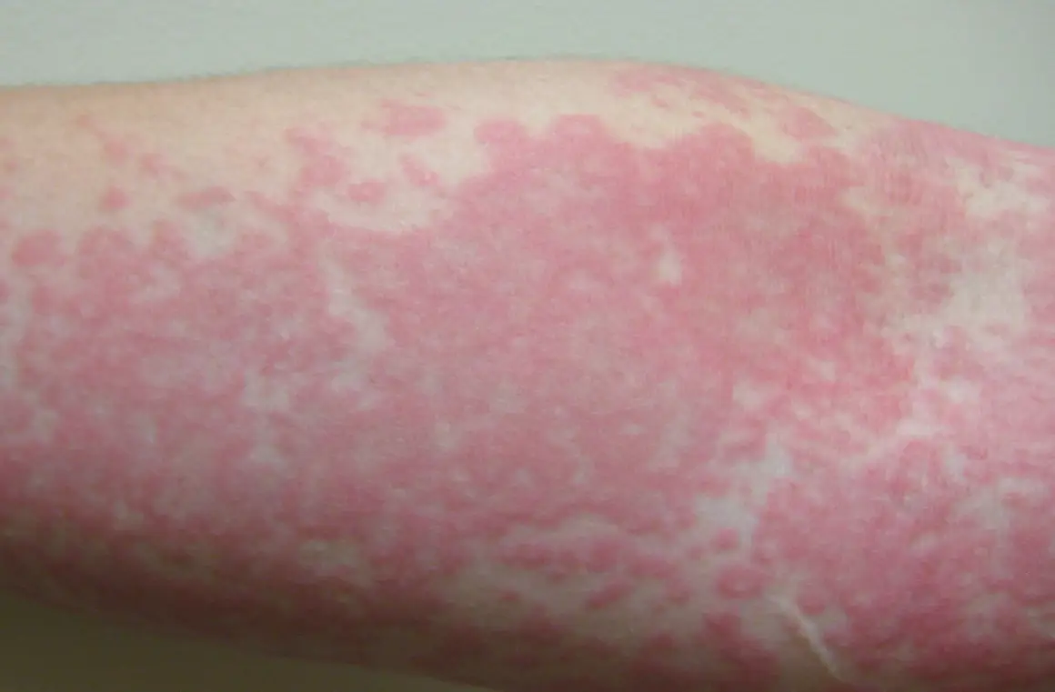 夜間蕁麻疹 夜間蕁麻疹