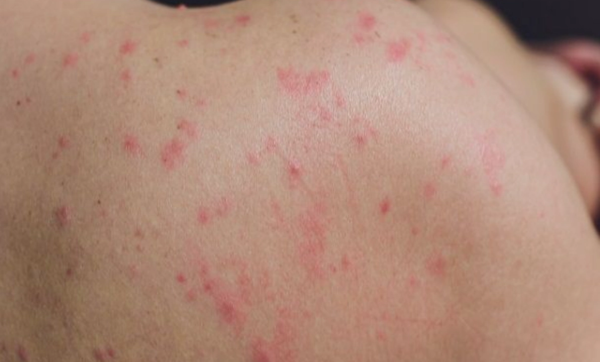 蕁麻疹止癢方法 蕁麻疹止癢方法