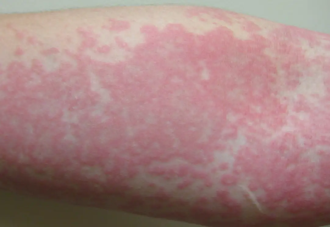 蕁麻疹緊急處理指南：皮膚科醫師教你在家緩解紅腫搔癢