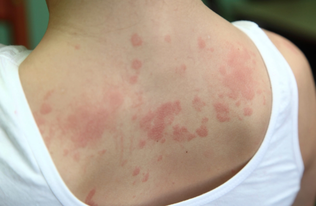 蕁麻疹止癢方法 蕁麻疹止癢方法