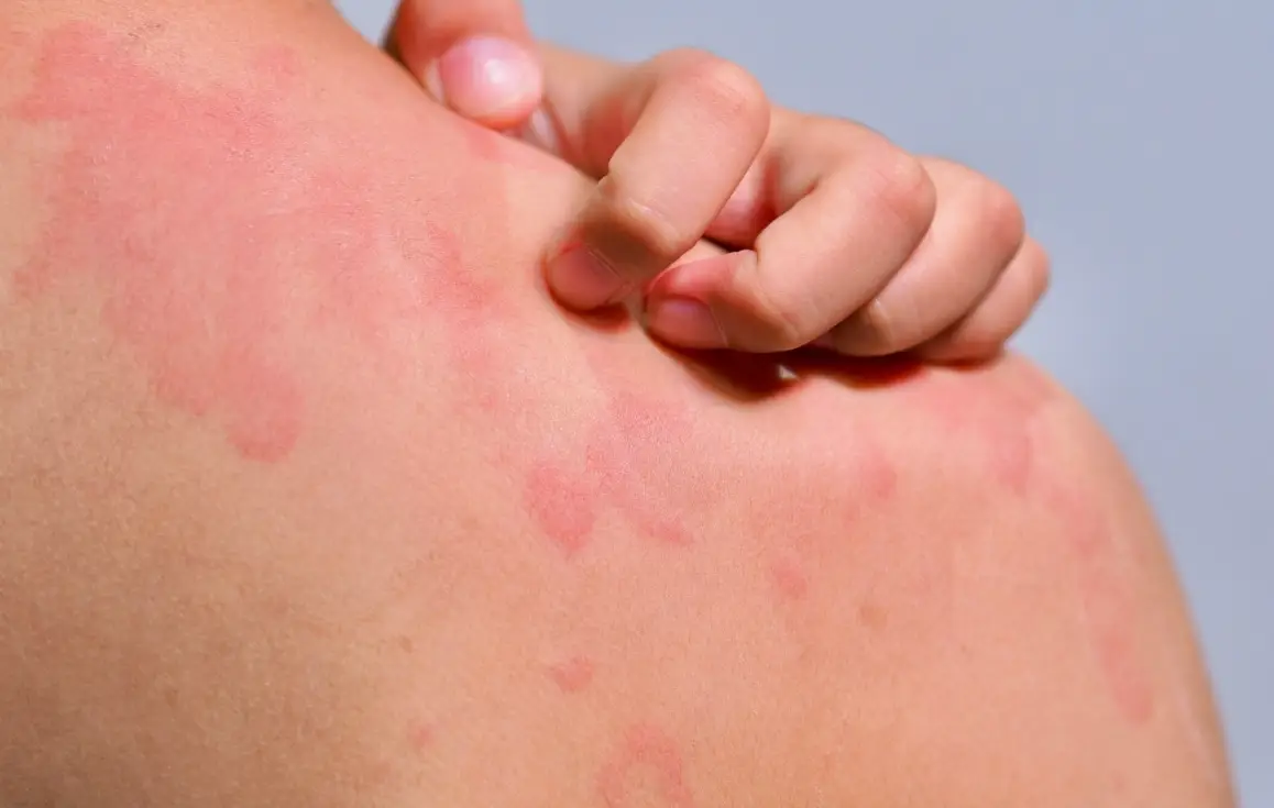 皮膚過敏 處理