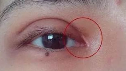 眼角痛治療
