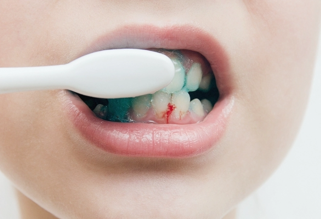 刷牙牙齦流血怎麼辦