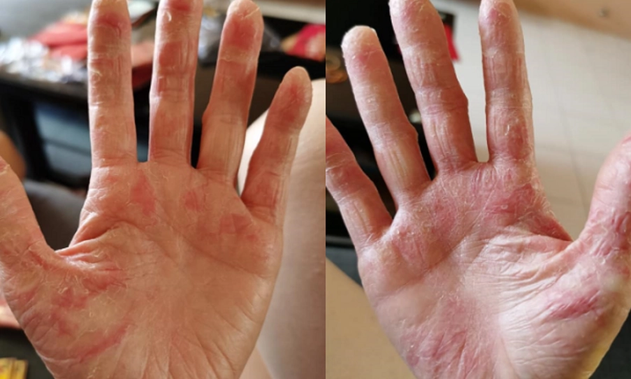 富貴手症狀