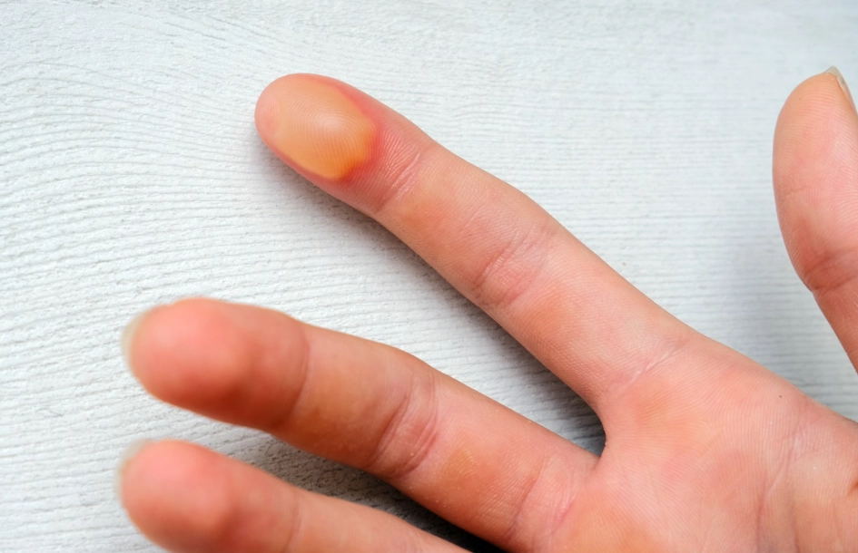 燙傷起水泡怎麼辦