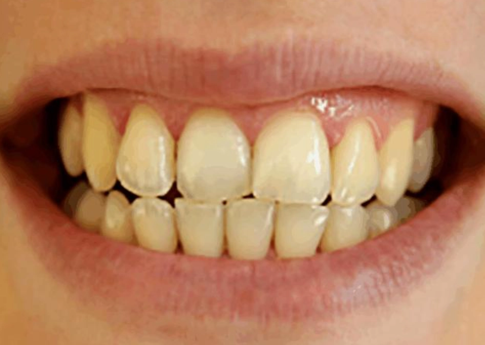 牙齒美白方法