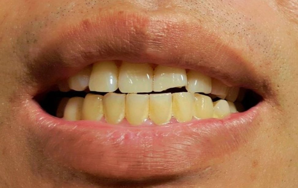 牙齒美白方法