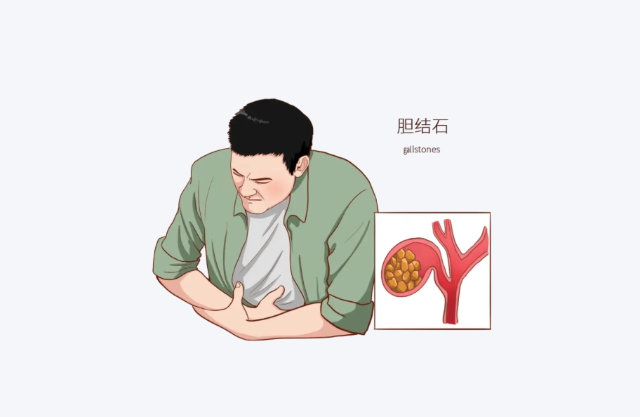 膽結石症狀