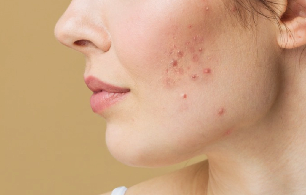 臉頰長痘原因