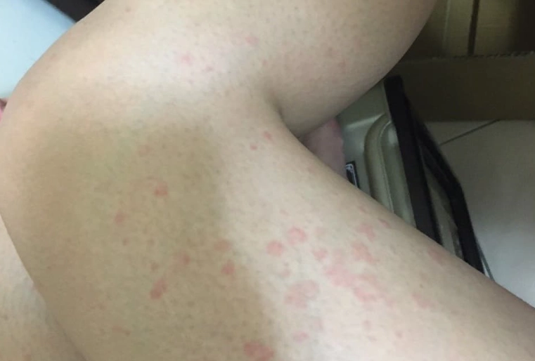 半夜蕁麻疹緊急處理