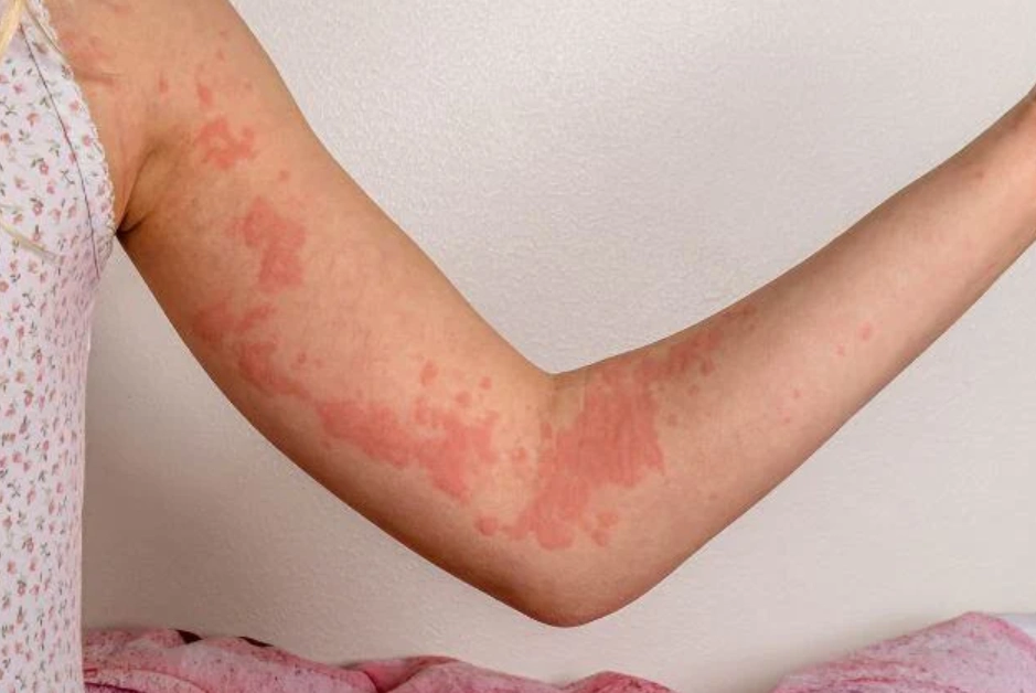 蕁麻疹止癢方法