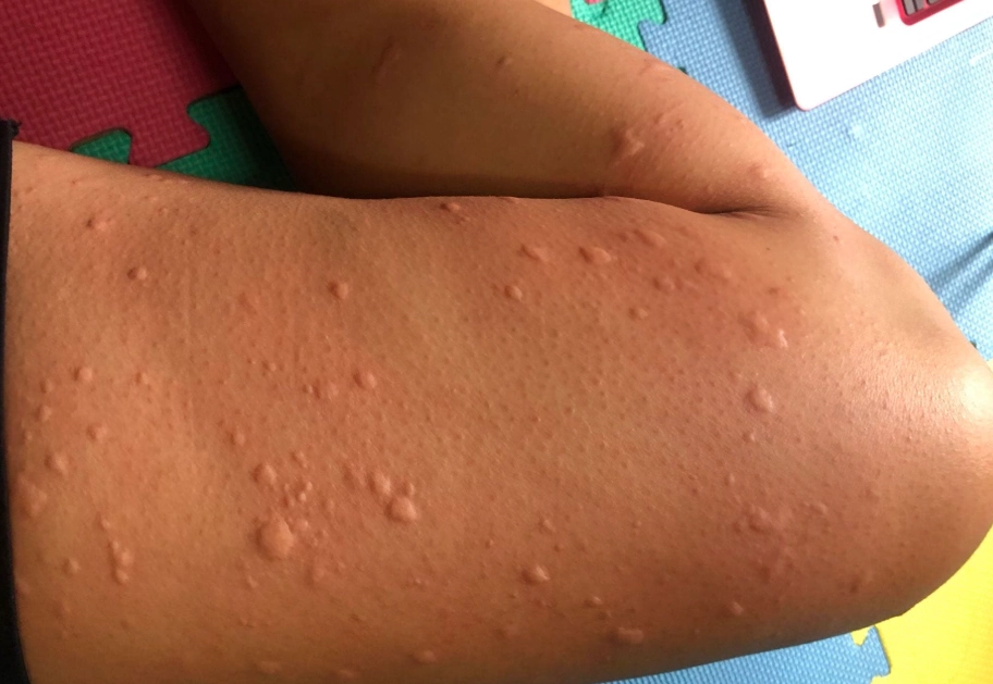 蕁麻疹止癢方法