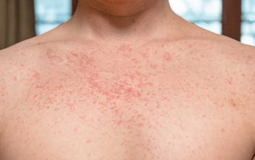 半夜蕁麻疹緊急處理