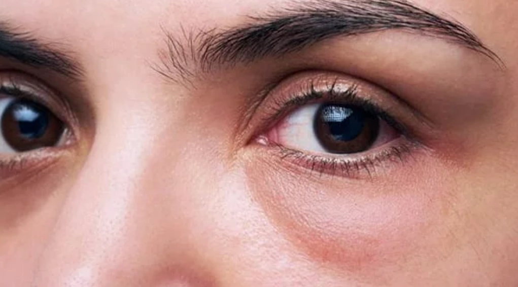 眼睛腫起來急救