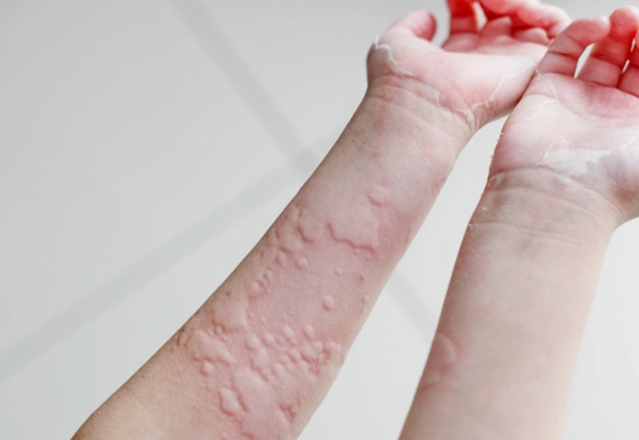 半夜蕁麻疹緊急處理